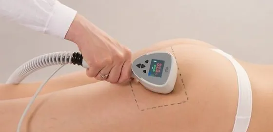 Radiofrequência Corporal (Exilis Ultra 360)